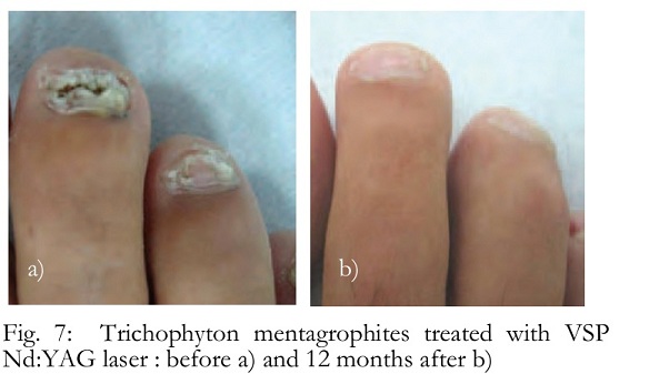lézeres eltávolítása láb köröm gomba nail gombák gyógyszeres kezelése