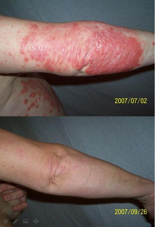 invazív pikkelysömör kezelése hogyan kell kezelni a kerek indurált vörös foltokat a testen